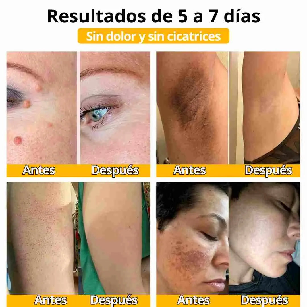 DILE ADIÓS A LAS MANCHAS, VERRUGAS O CICATRICES NO DESEADAS