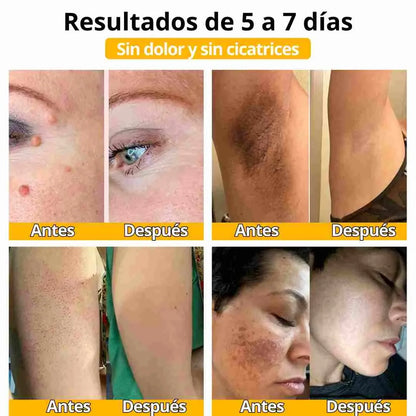 DILE ADIÓS A LAS MANCHAS, VERRUGAS O CICATRICES NO DESEADAS