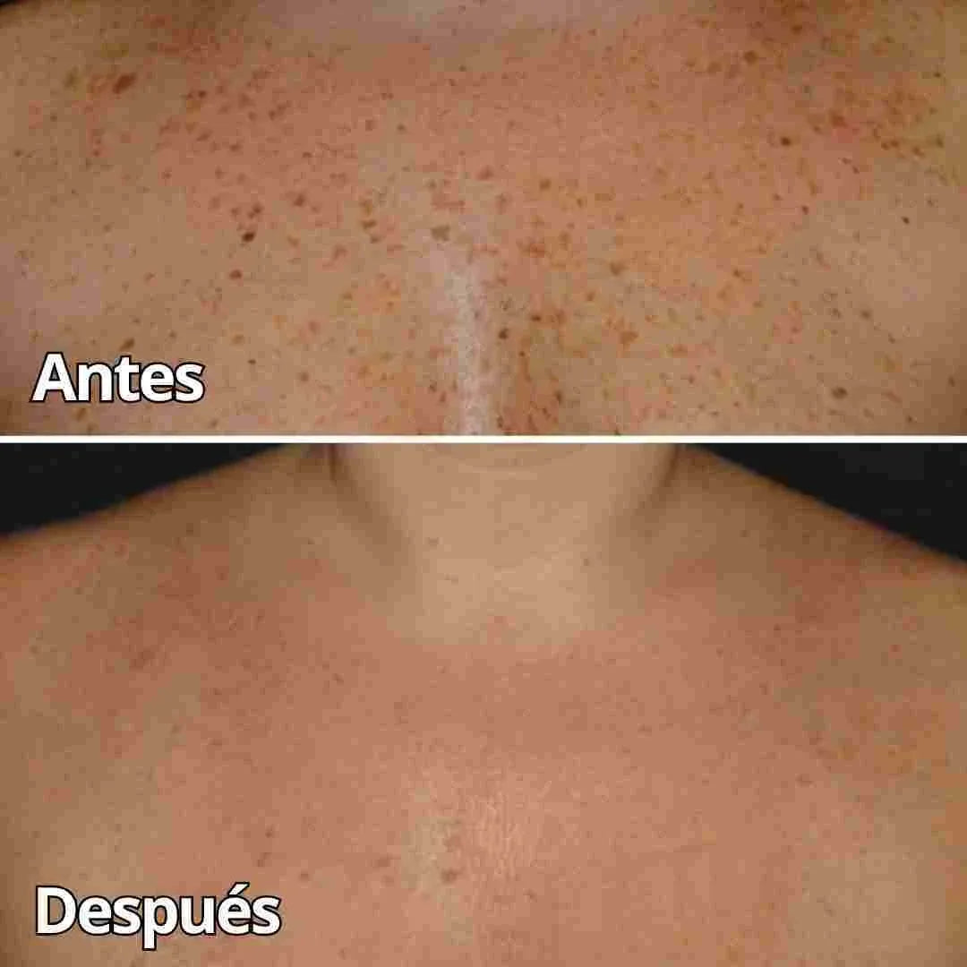 DILE ADIÓS A LAS MANCHAS, VERRUGAS O CICATRICES NO DESEADAS